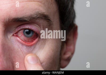 Nahaufnahme von einem schweren blutunterlaufene Auge. Blepharitis, Konjunktivitis Zustand Stockfoto