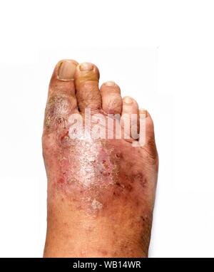 Der menschliche Fuß ist eine Pilzinfektion der Haut Läsionen auf weißem Hintergrund, Fußpilz, Dermatophyten oder Tinea pedis, Candida albicans Stockfoto