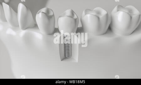 Ein Implantat im Kiefer - 3d-Rendering Stockfoto