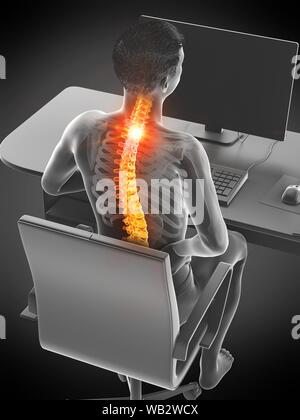 Büroangestellter mit Rückenschmerzen, konzeptionelle Darstellung. Stockfoto