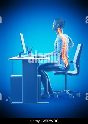Büroangestellter mit Rückenschmerzen, konzeptionelle Darstellung. Stockfoto