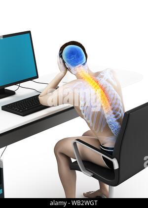 Büroangestellter mit Rückenschmerzen, konzeptionelle Darstellung. Stockfoto
