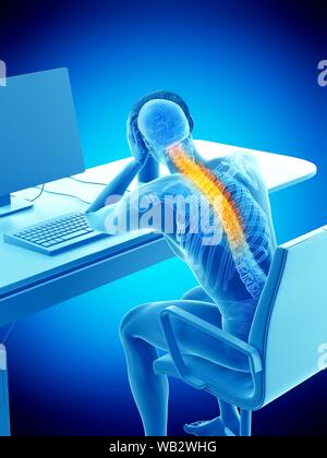 Büroangestellter mit Rückenschmerzen, konzeptionelle Darstellung. Stockfoto