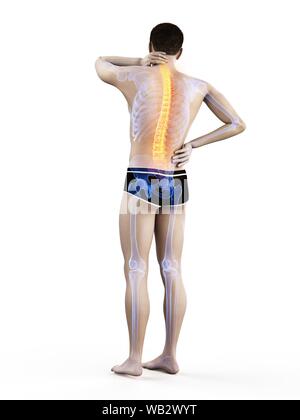 Rückenschmerzen, konzeptionelle Darstellung. Stockfoto