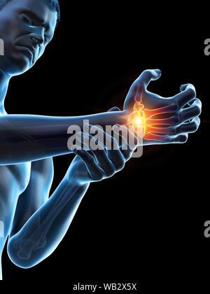Handgelenk Schmerzen, konzeptionelle Darstellung. Stockfoto