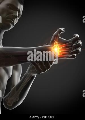Handgelenk Schmerzen, konzeptionelle Darstellung. Stockfoto