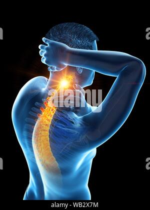 Nackenschmerzen, konzeptionelle Darstellung. Stockfoto