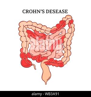 CROHN KRANKHEIT Darm Medizin Regelung Anatomie der menschlichen Handdraw Vector Illustration Stock Vektor