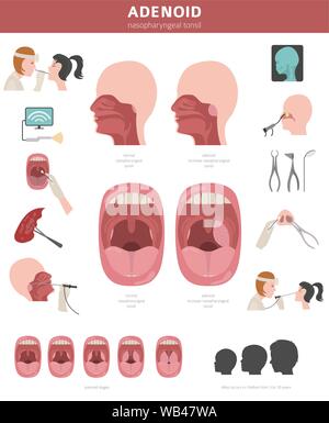 Nasen- und Rachenraum, nasenrachen Krankheiten. Adenoids Diagnose und Behandlung medizinische Infografik Design. Vector Illustration Stock Vektor