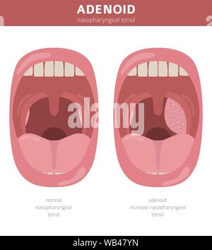 Nasen- und Rachenraum, nasenrachen Krankheiten. Adenoids Diagnose und Behandlung medizinische Infografik Design. Vector Illustration Stock Vektor