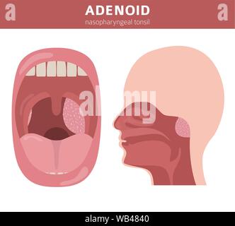 Nasen- und Rachenraum, nasenrachen Krankheiten. Adenoids Diagnose und Behandlung medizinische Infografik Design. Vector Illustration Stock Vektor