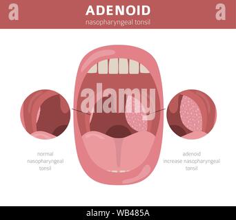 Nasen- und Rachenraum, nasenrachen Krankheiten. Adenoids Diagnose und Behandlung medizinische Infografik Design. Vector Illustration Stock Vektor