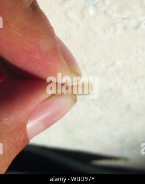Gefallenen aus alte Füllung mit einem Cutter. Die Dichtung der Zahn Stockfoto