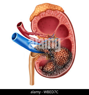 Menschliche Niere Krebs Anatomie medizinisches Konzept als cancerouse Zellen im menschlichen Körper in Angriff nehmen der Harnwege und der Nieren Anatomie. Stockfoto