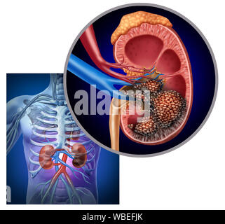 Krebs der Niere medizinisches Konzept als bösartige Zellen im menschlichen Körper in Angriff nehmen der Harnwege und der Nieren Anatomie. Stockfoto