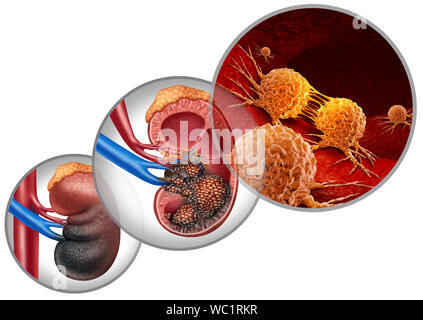 Nierenkrebs Krankheit medizinisches Konzept als bösartige Zellen im menschlichen Körper in Angriff nehmen der Harnwege und der Nieren Karzinom Anatomie als Symbol. Stockfoto