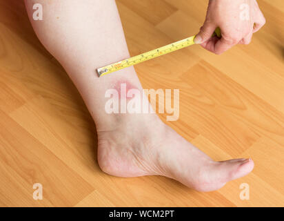 Einzelner großer Pferdebiss auf dem linken Bein über dem Knöchel mit gelbem Maßband Stockfoto