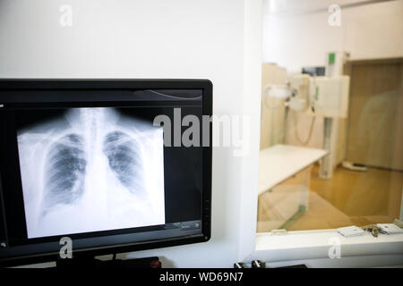 Details mit einem Thorakalen X-Ray auf einem Computer Monitor innerhalb einer Klinik Stockfoto