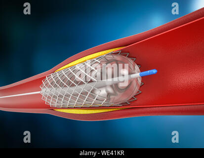 3D-rendering Ballon Angioplastie, Stent in der Vene Stockfoto