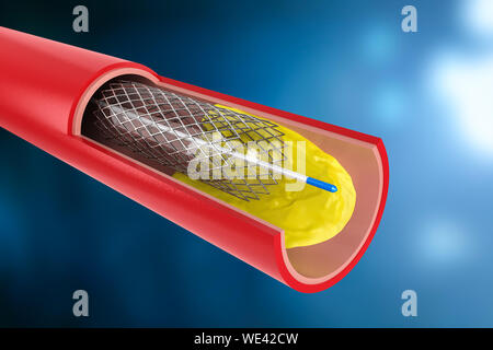 3D-rendering Ballon Angioplastie, Stent in der Vene Stockfoto