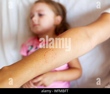 Kleinkind weiblichen beißen den Arm der Mutter. Kinder Gesicht Phasen des Wachstums, einschließlich Beißen. Stockfoto