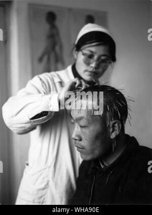 Akupunktur. China Peking. Akupunktur in der Tseng ich Yen Krankenhaus der Traditionellen Medizin. Stockfoto