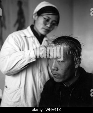 Akupunktur. China Peking. Akupunktur in der Tseng ich Yen Krankenhaus der Traditionellen Medizin. Stockfoto