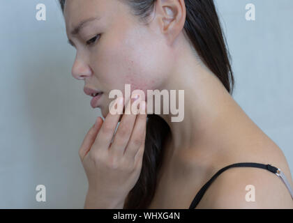 Betonte Frau heraus brechen mit Akne im Gesicht. Stockfoto