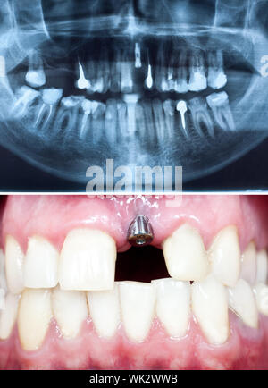 Eine Makroaufnahme von Zahnimplantaten in der Mundhöhle und der Panorama Zahnröntgen Stockfoto