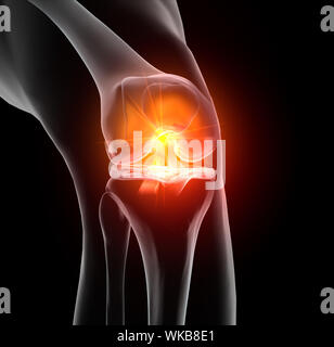 Genaue medizinisch 3D-Abbildung: schmerzhafte Kniegelenk mit hervorgehobenen anterioren und posterioren Kreuzband, Meniskus, Gelenkknorpel Stockfoto