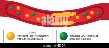 Atherosklerotischen Plaque in der Gefäß- und gute und schlechte Fette vektor Infografiken Stock Vektor