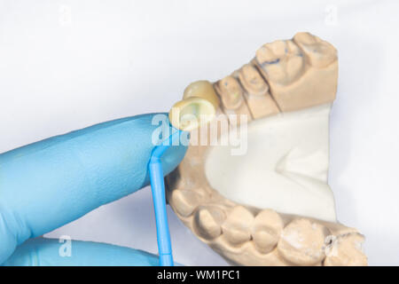 Keramische Kronen Veneers auf einem Gips Modell der menschlichen Zähne Nahaufnahme Makro in die Hand des Zahnarztes in einem blau-Handschuh. Stockfoto