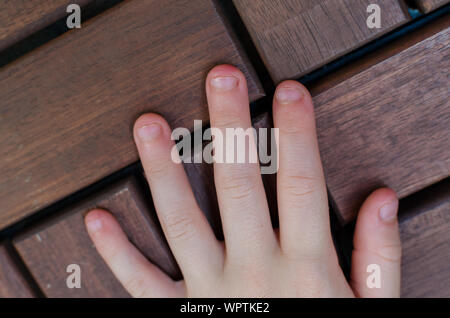 Gebissen Fingernägel - Finger gebissen. In der Nähe der Hände mit Gebissen Finger und Fingernägel Stockfoto