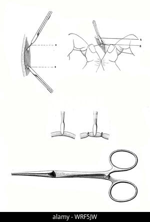 Chirurgie und Medizin - blutstillung Schelle, chirurgische Instrument zu Blutungen während einer Operation vor dem Sichern mit einer Ligatur. Stockfoto