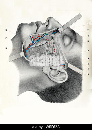 Chirurgie und Medizin-Wange Region: suborbital, preauricolar und buccomandibular zonee mit Gesichts Muskulatur ausgesetzt, Gesichts Arterie und Vene Stockfoto