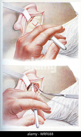 Chirurgie und Medizin - trepanation Der mastoid Prozess, den knöchernen Vorsprung hinter dem Ohrläppchen Stockfoto