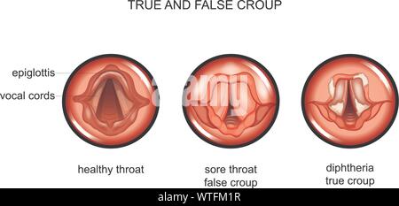 Vector Illustration an Diphtherie. true und false Kruppe Stock Vektor