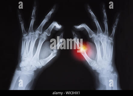 Die menschliche Hand x-ray rot markiert Stockfoto