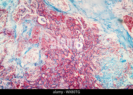 Gemischte Tumor der Ohrspeicheldrüse krankes Gewebe 100x Stockfoto