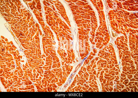 Chronische Myokarditis krankes Gewebe 100x Stockfoto