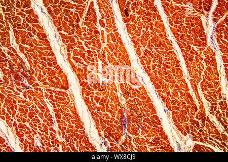 Chronische Myokarditis krankes Gewebe 100x Stockfoto