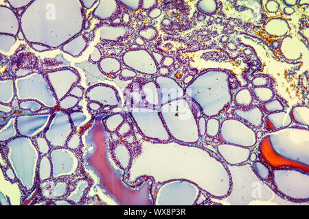 Kropf Schilddrüsestörung 100x Stockfoto