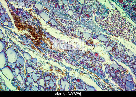 Kropf Schilddrüsestörung 100x Stockfoto