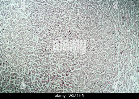 Leber mit Hepatitis Marker krankes Gewebe unter dem Mikroskop 100x Stockfoto