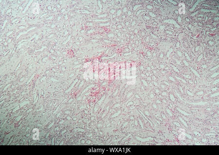 Poly Nephritis Nephritis, Gewebe unter dem Mikroskop 100x Stockfoto