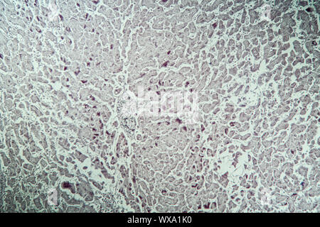 Leber mit Hepatitis Marker krankes Gewebe unter dem Mikroskop 100x Stockfoto