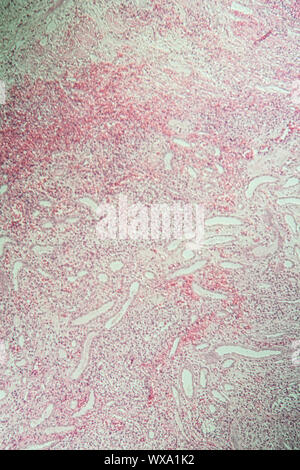 Poly Nephritis Nephritis, Gewebe unter dem Mikroskop 100x Stockfoto