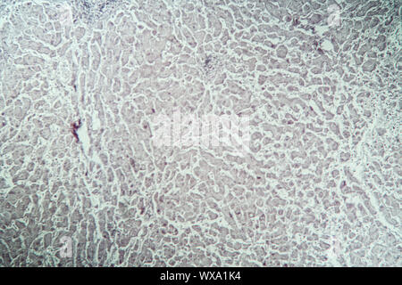 Leber mit Hepatitis Marker krankes Gewebe unter dem Mikroskop 100x Stockfoto