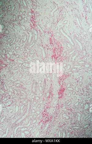 Poly Nephritis Nephritis, Gewebe unter dem Mikroskop 100x Stockfoto