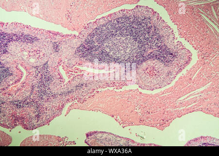 Zyste adenolymphoma krankes Gewebe unter dem Mikroskop 100x Stockfoto